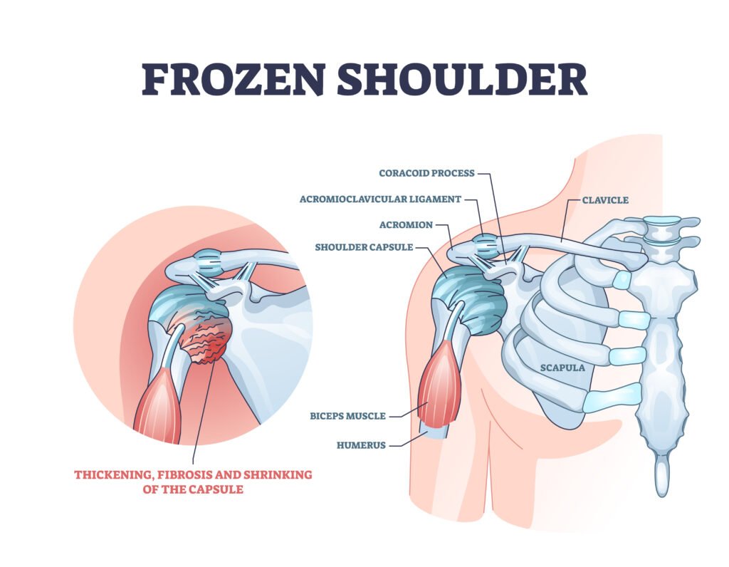 frozen shoulder