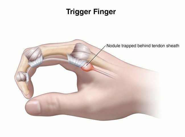 Trigger Finger