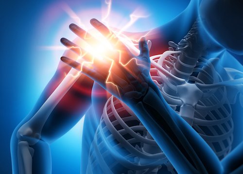 Frozen shoulder, also known as adhesive capsulitis, is a condition that causes pain and stiffness in the shoulder joint, significantly limiting movement.
