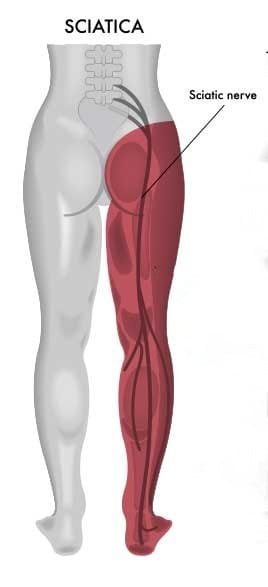 Sciatica